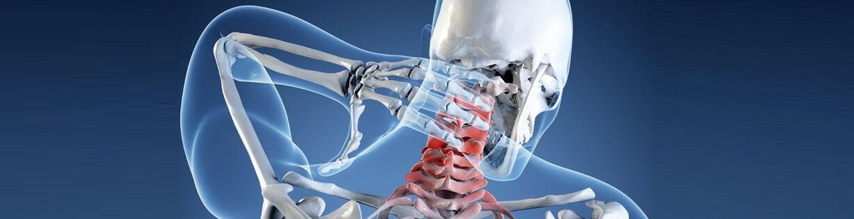 انسانی گریوا ریڑھ کی ہڈی کے Osteochondrosis کے