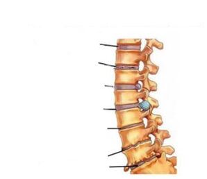 آسٹیوچنڈروسس کی علامات