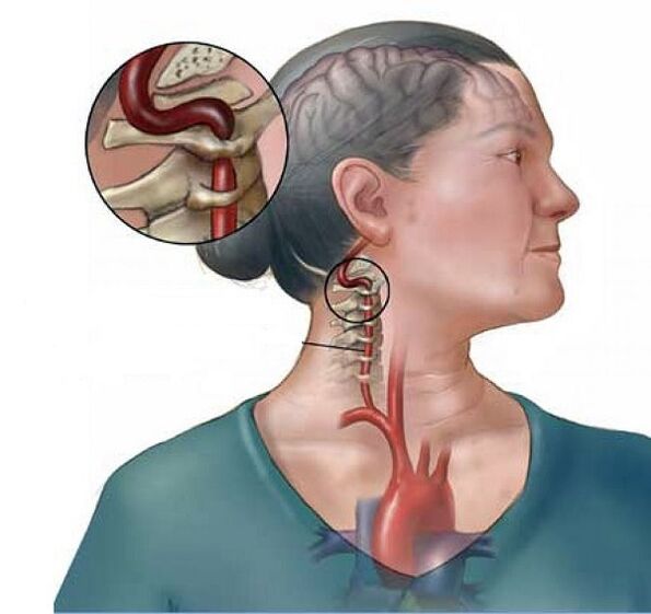 گریوا آسٹیوچنڈروسس کے ساتھ کشیرکا دمنی سنڈروم