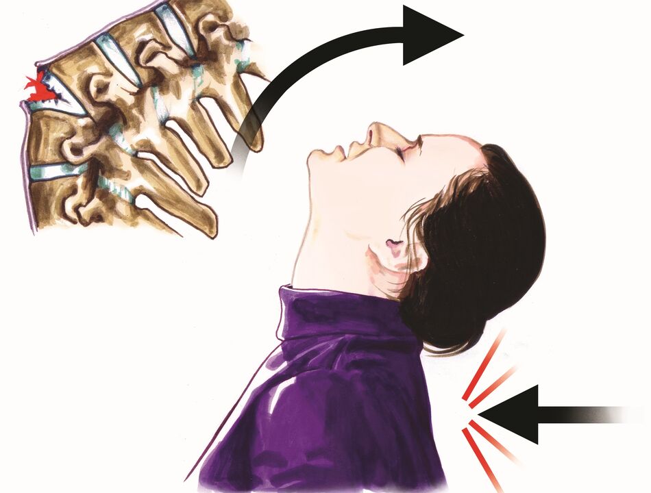 گردن کے درد کی وجہ کے طور پر ریڑھ کی ہڈی کا نقصان